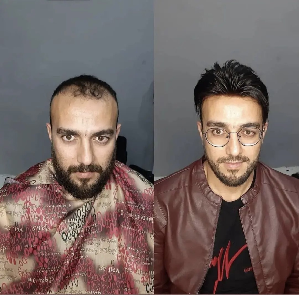 بهترین کلینیک پروتز مو در مازندران