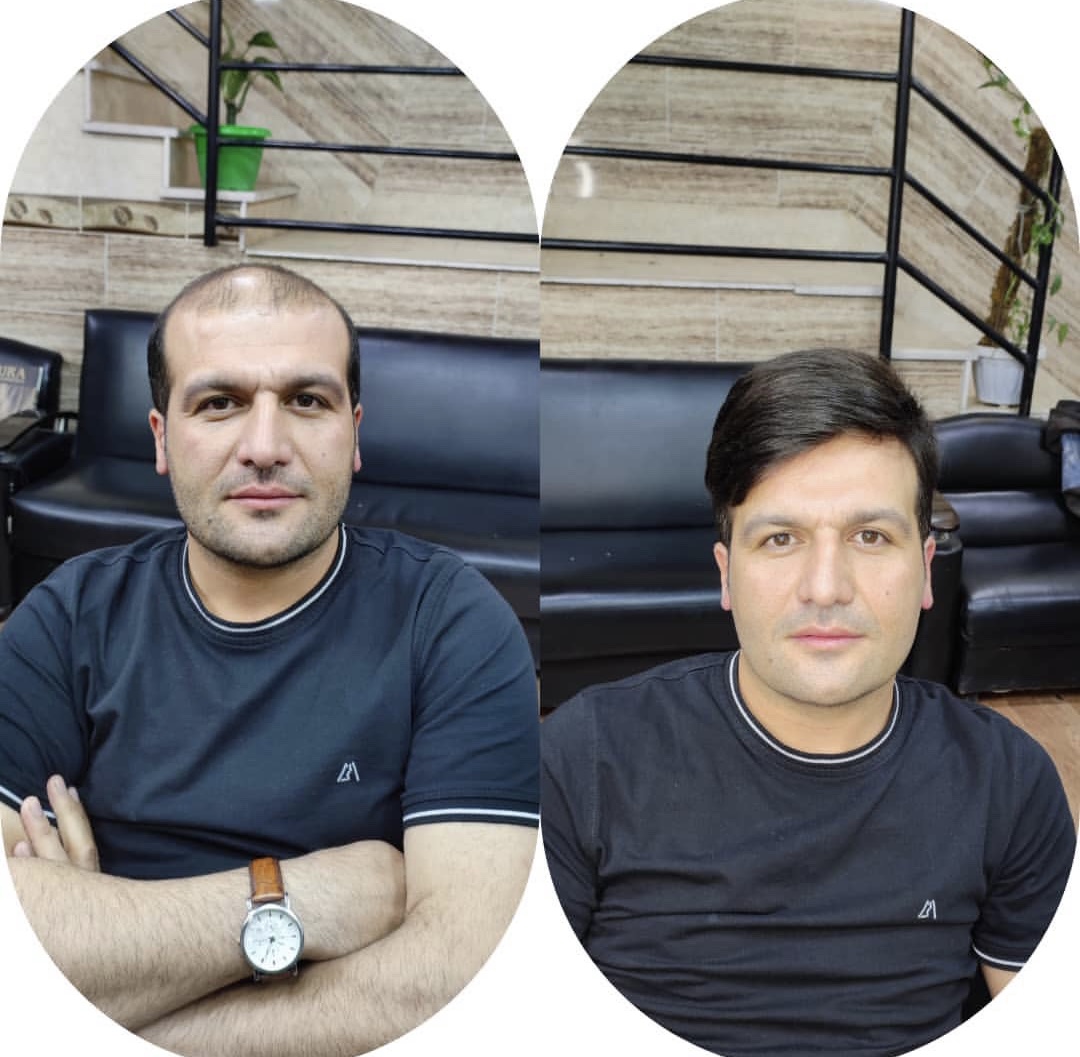 بهترین کلینیک پروتز مو در مازندران