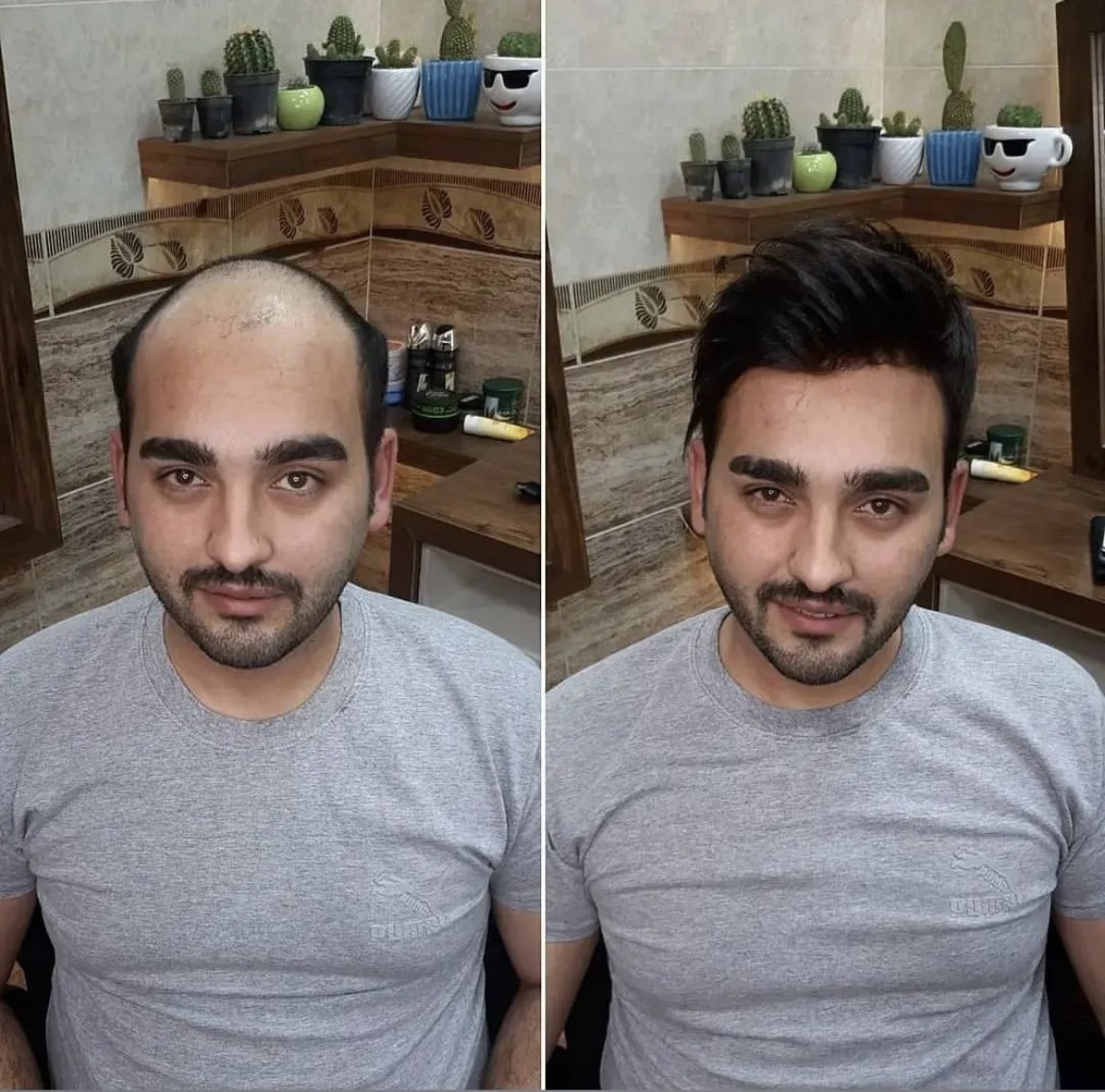 بهترین کلینیک پروتز مو در مازندران