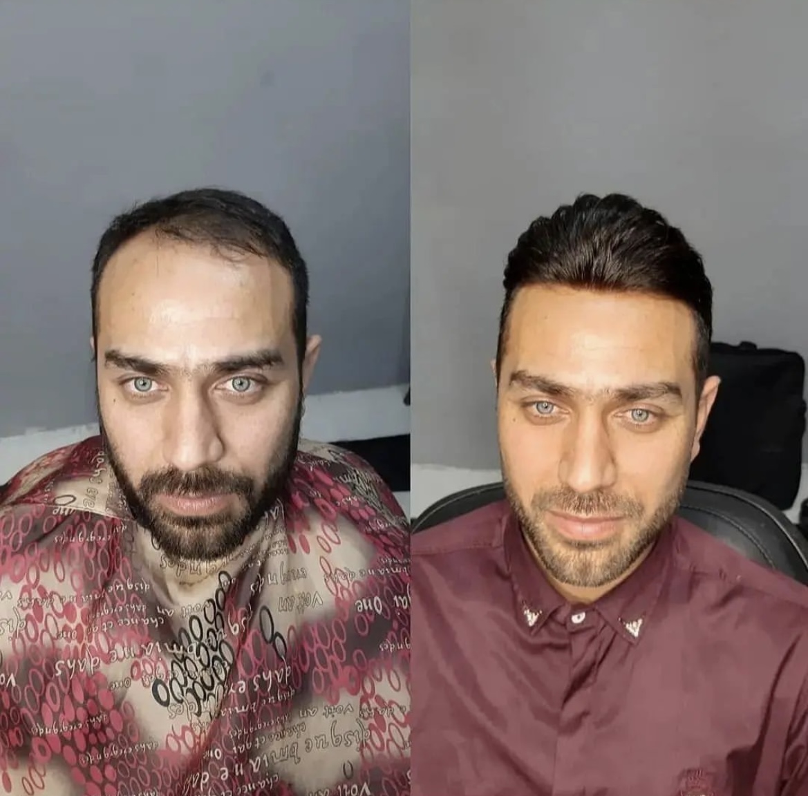 بهترین کلینیک پروتز مو در مازندران