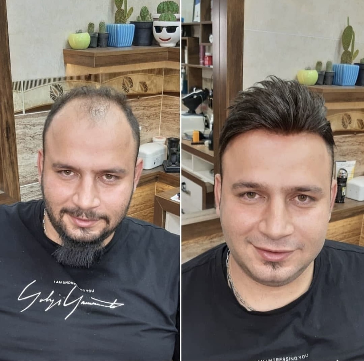 بهترین کلینیک پروتز مو در مازندران