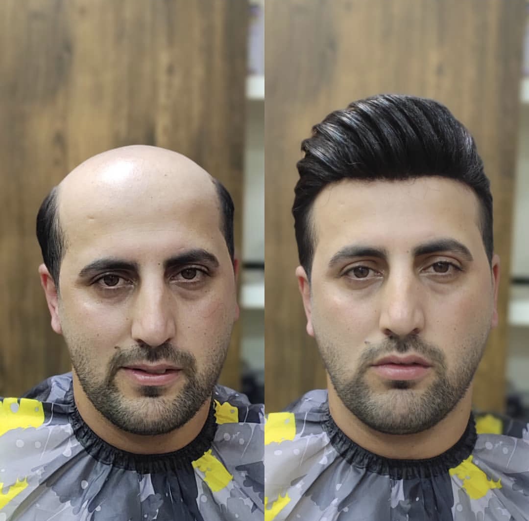 بهترین کلینیک پروتز مو در مازندران