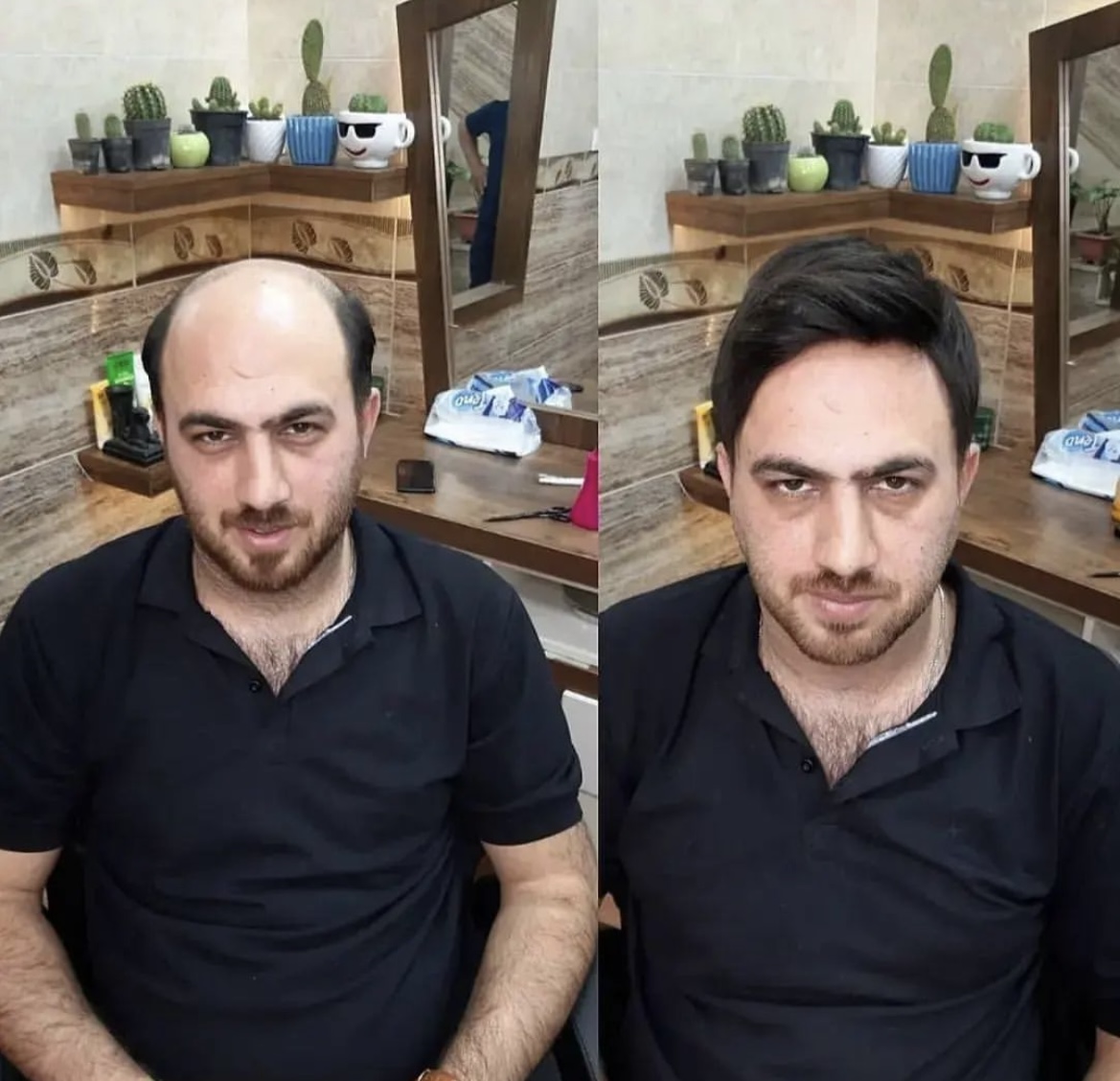 بهترین کلینیک پروتز مو در مازندران