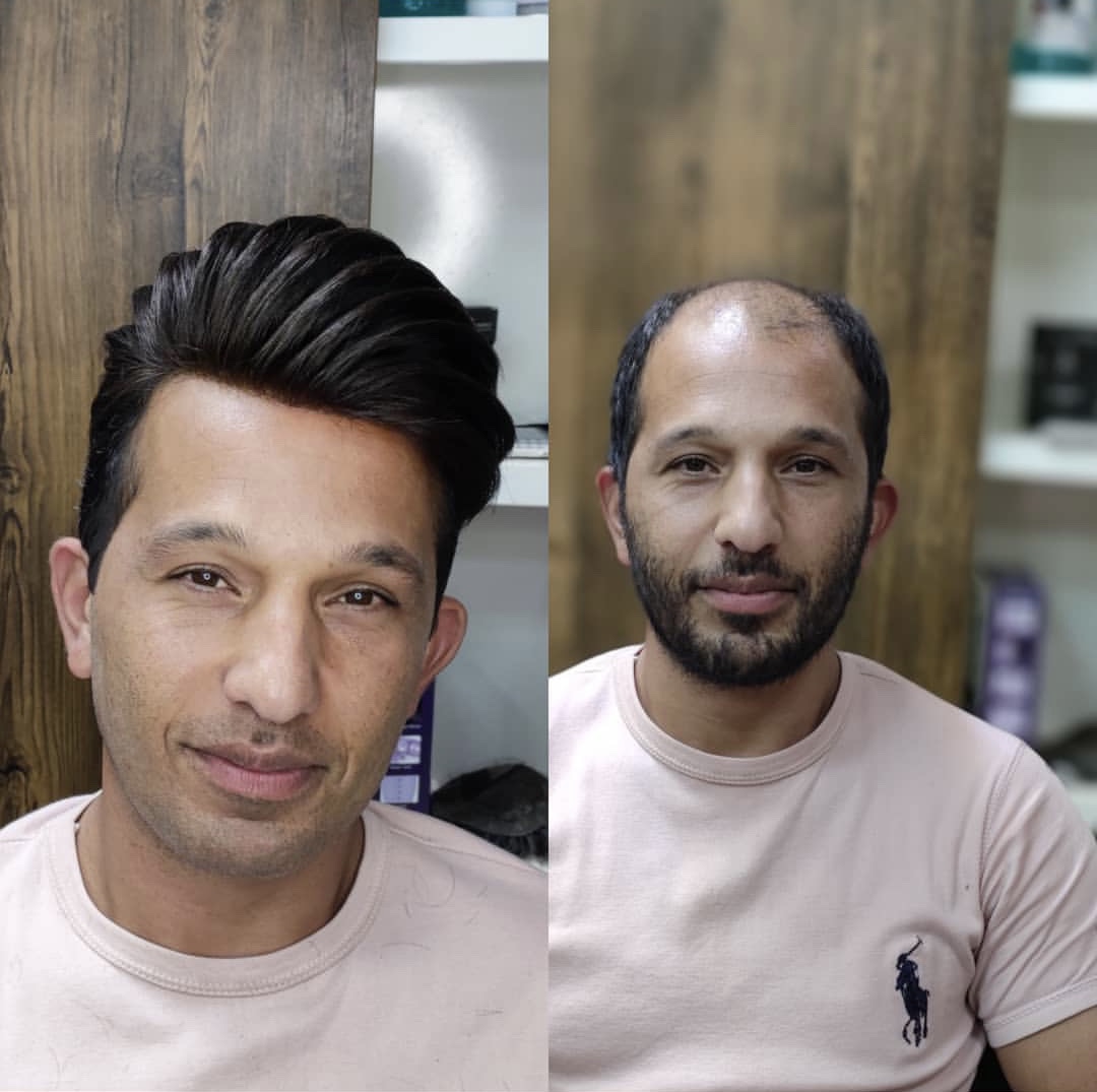 بهترین کلینیک پروتز مو در مازندران