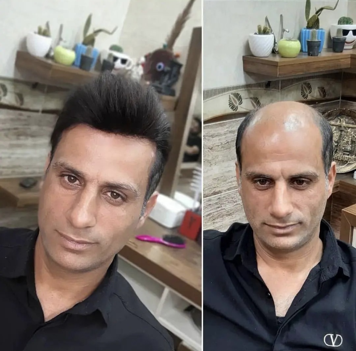 بهترین کلینیک پروتز مو در مازندران